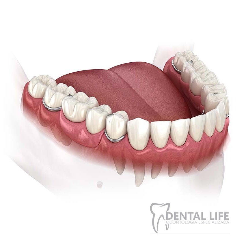 Planejamento de implantes dentários em Curitiba.