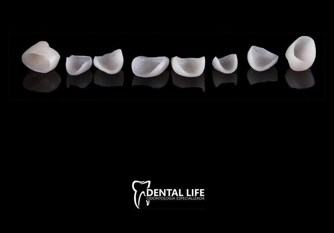 Lâminas e facetas cerâmicas para odontologia estética