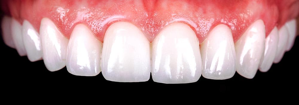 Depois do tratamento com facetas