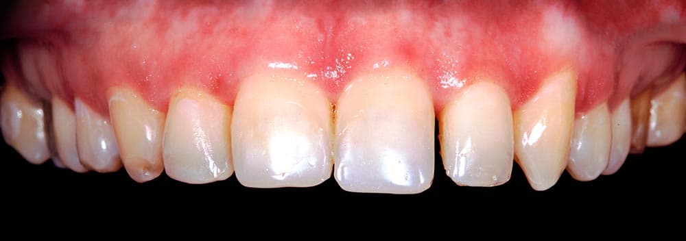 Antes do tratamento com facetas