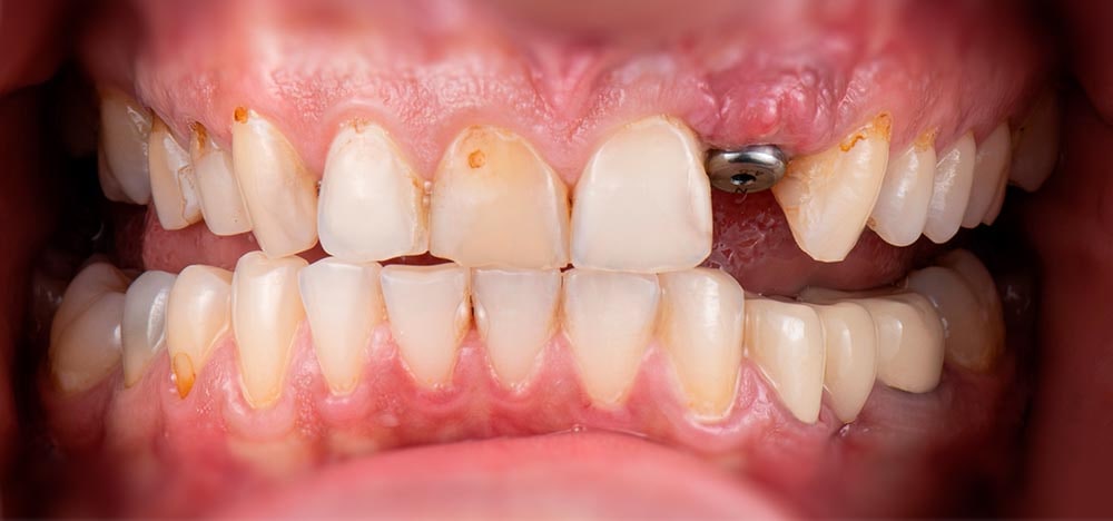 Antes da reabilitação com prótese: dentes ausentes e desgastados.