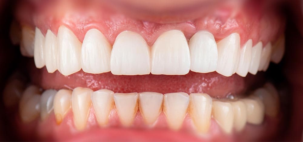 Depois da reabilitação com prótese