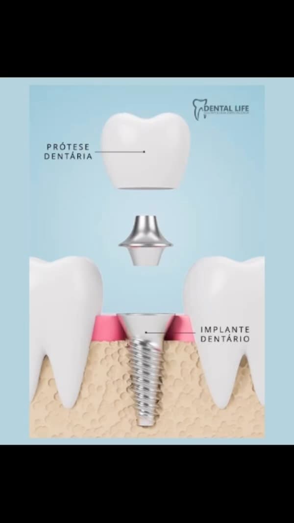 Tratamento com implantes dentarios em Curitiba.