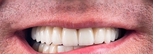 Sorriso de paciente atendido na clínica, com a arcada completa.